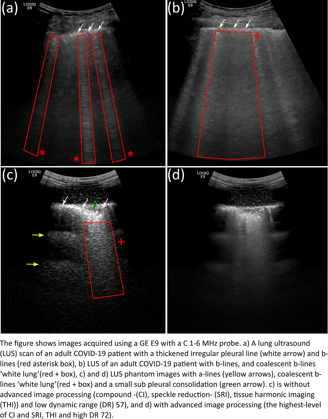 A scientific image of a lung ultrasound.