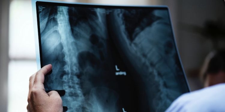 Leeds University academics part of consortium researching new spinal treatments